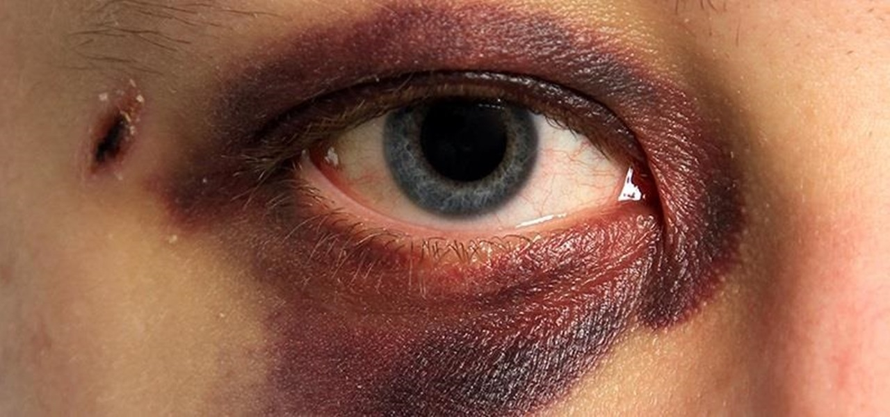 Purple Black Eye Makeup How To Make Black Eyes Bruises Hickeys Fade Heal Faster In 5
